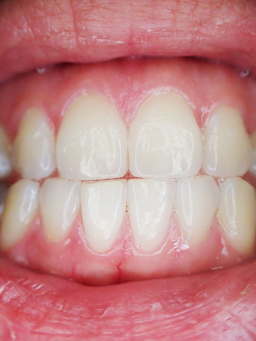 : closeup of person's teeth, mouth, dental, Dentist HD phone wallpaper