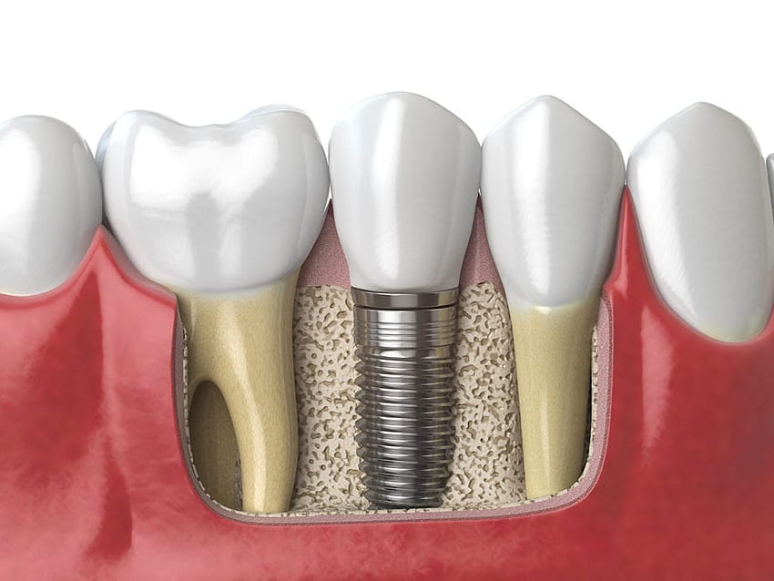 O que são implantes dentários Lexington KY papel de parede HD