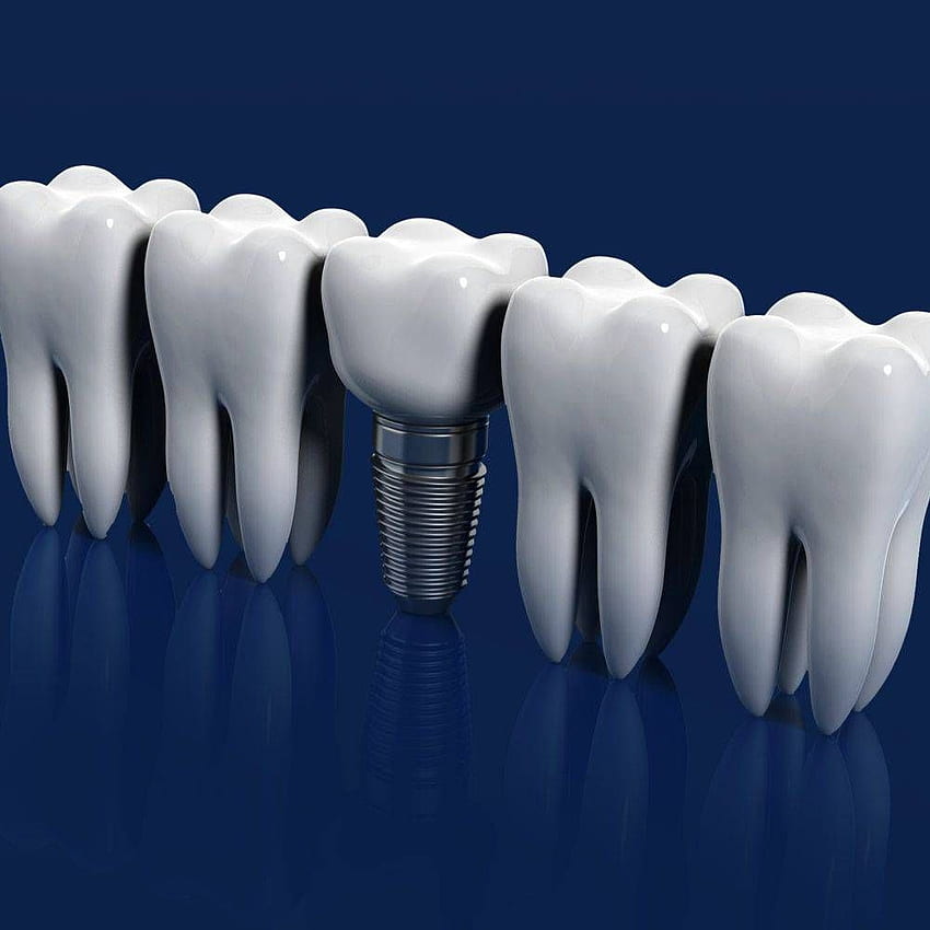 Impianti dentali Fairfax, VA - Odontoiatria implantare - Cura dentale della famiglia Fairfax, salute dentale Sfondo del telefono HD