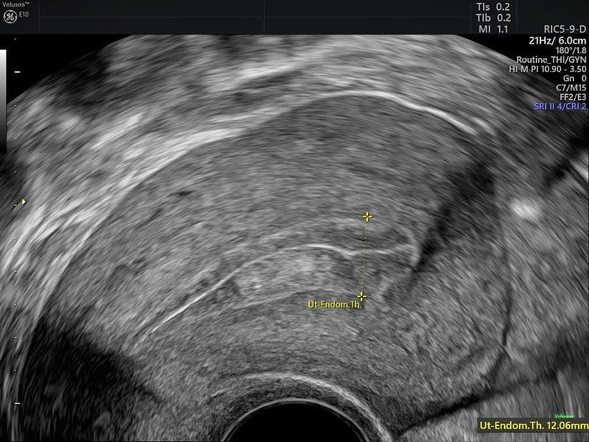 Endometrial Hyperplasia Diagnosis: Ultrasound Before Biopsy. Empowered Women's Health HD wallpaper