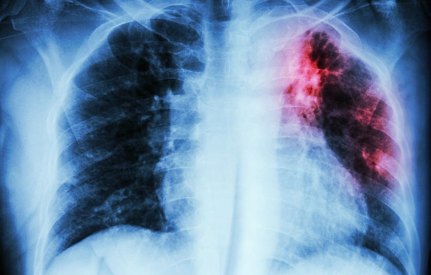 macchia, malattia, polmoni, radiografia, infezione per , sezione текстуры Sfondo HD