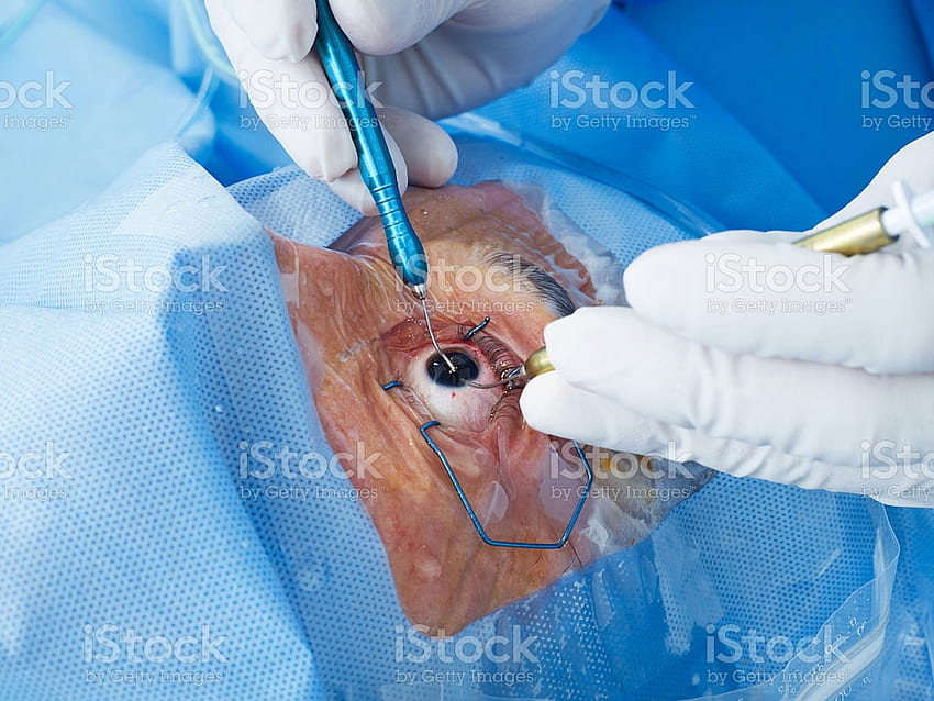 Eye Surgery Closeup Stock - Cataract Surgeon - - HD wallpaper
