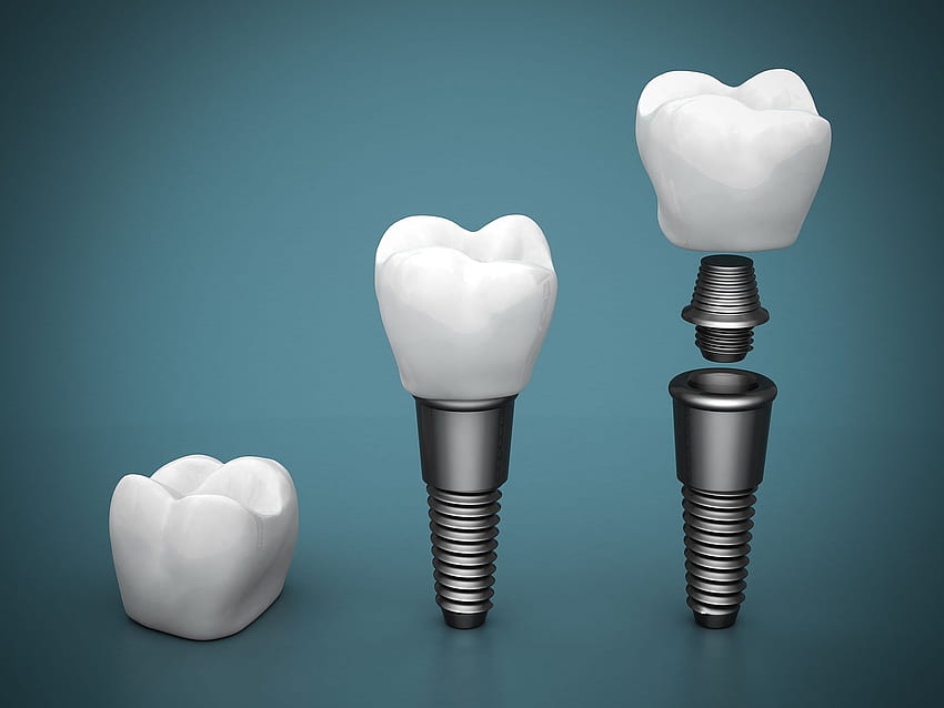 Implantate - Teile Zahnimplantat HD-Hintergrundbild