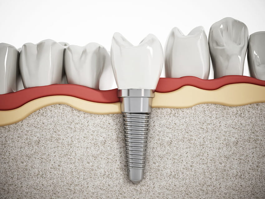 Implantes dentários em South Bend, IN. Tulip Tree Dental Care papel de parede HD