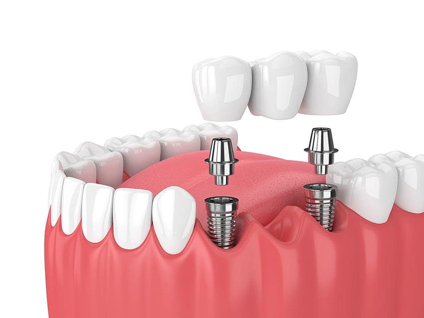 インディアナポリス、インディアナポリスで歯を失った場合の複数の歯科インプラント 高画質の壁紙