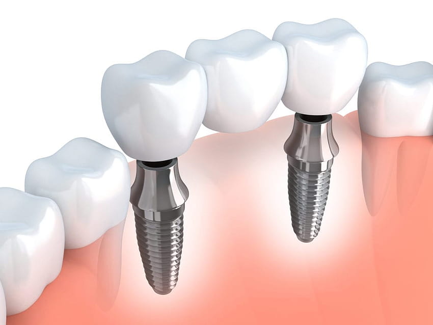 Implantes dentales de múltiples dientes Burlington NC fondo de pantalla