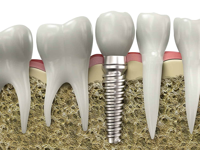 The Cost of Dental Implants in Los HD wallpaper