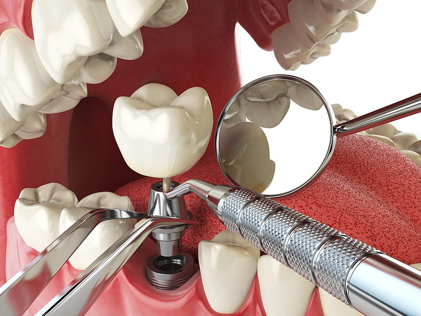 Perguntas Cirurgia de Implante Dentário. Implantodontista CT Implantodontia papel de parede HD
