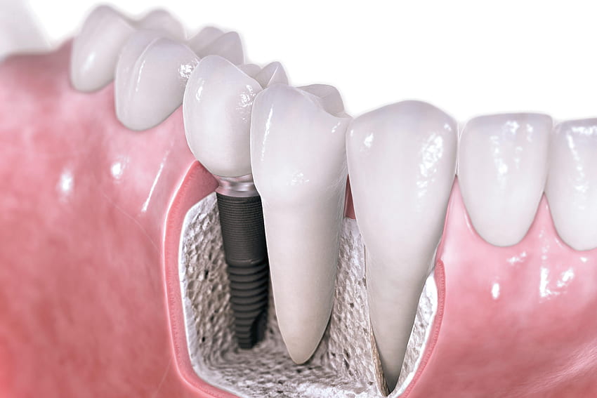 Implantes Dentários - Clínica Odontológica Além do Sorriso papel de parede HD
