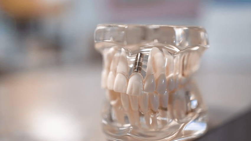Dental Implants. A Shop for Smiles – Richard J Hagstrom DDS HD wallpaper