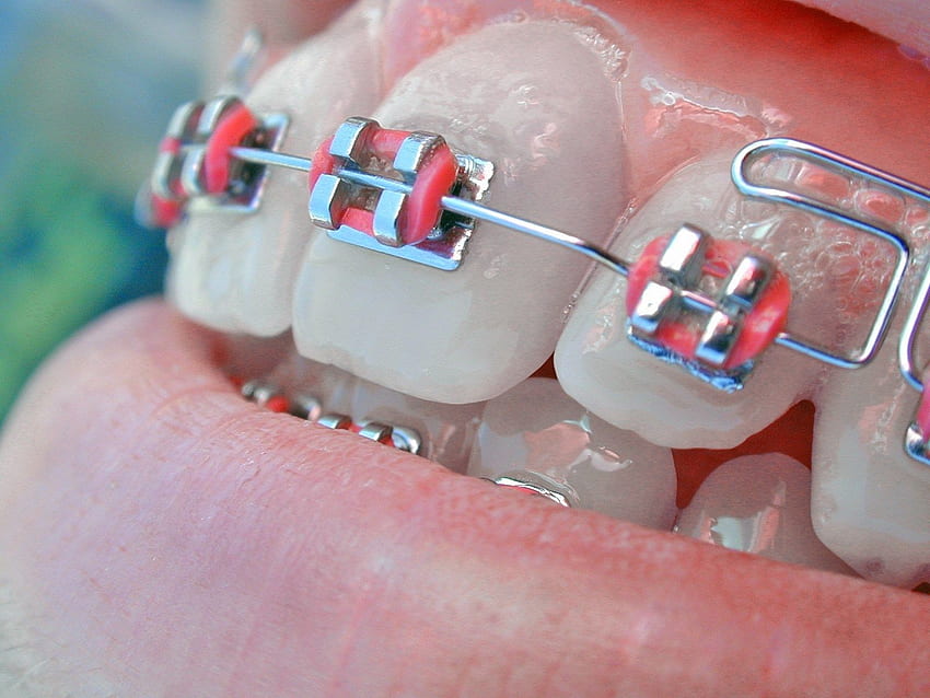 Cos'è il trattamento ortodontico? Ulteriori informazioni su tipi e trattamenti, apparecchi ortodontici Sfondo HD