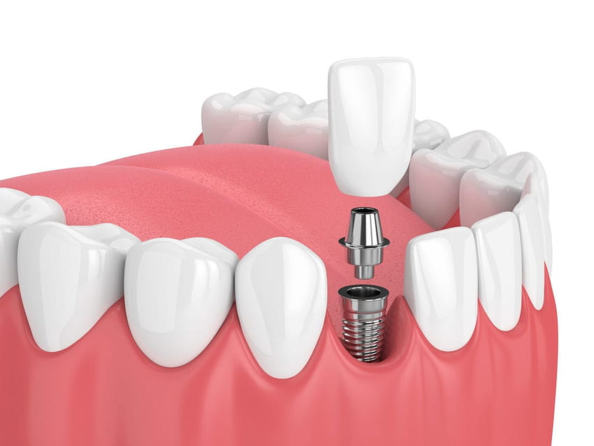 Implantes Dentários Timonium MD. Implante de dente unitário Towson papel de parede HD