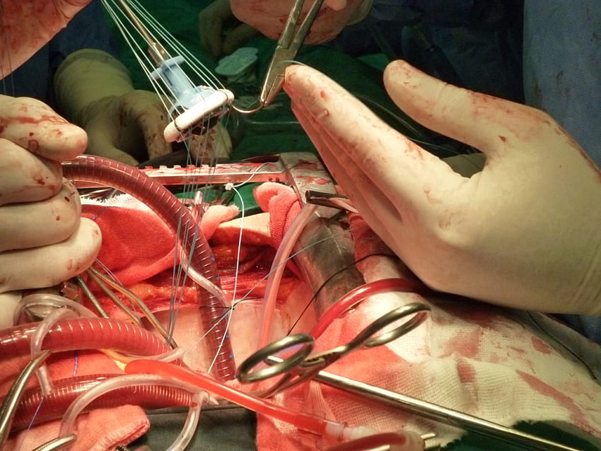 Opération de chirurgie à cœur ouvert Fond d'écran HD