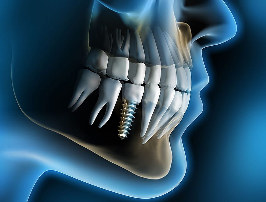 歯科インプラントおよび補綴物、歯科医 高画質の壁紙