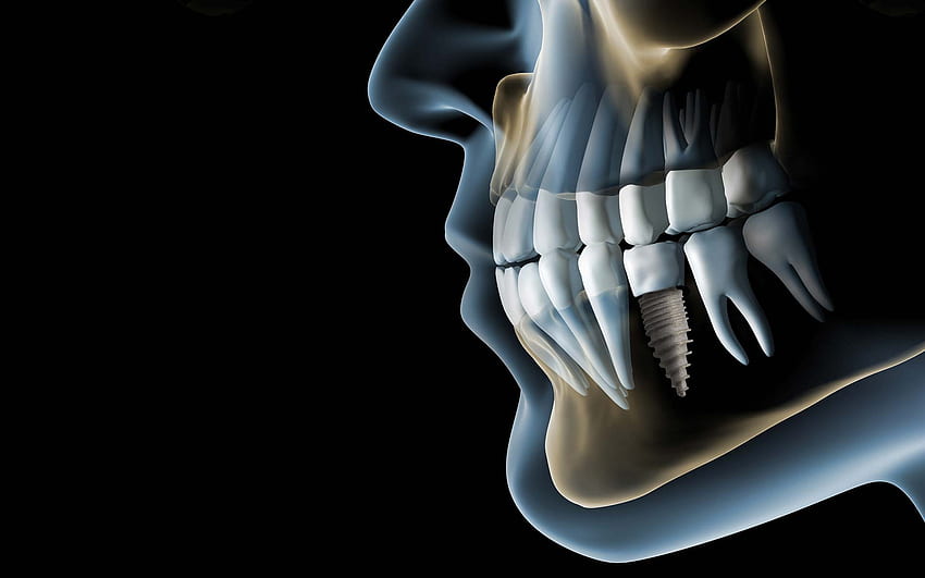 Il trattamento implantare si riferisce ad una Clinica Odontoiatrica di Dental S. Arora - 9911113362 Sfondo HD