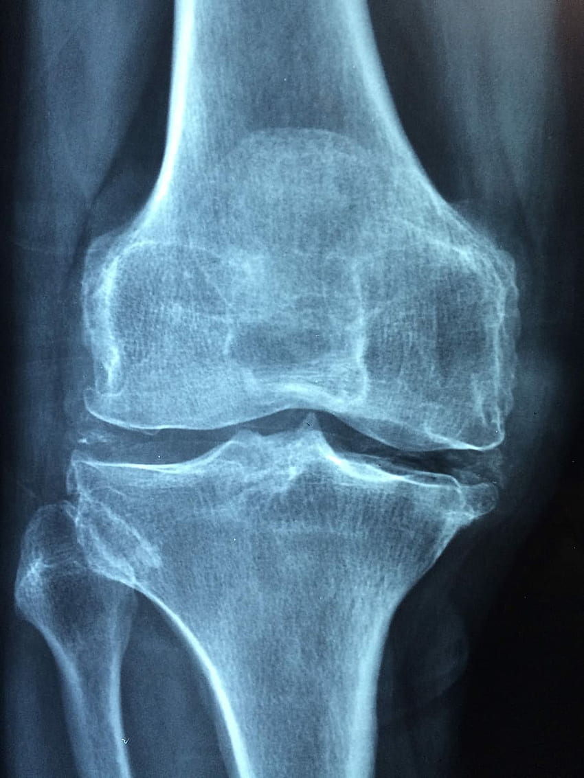 : X Ray Results On Bone, Knee, Old, Care, Injury, Pain, Radiology HD phone wallpaper
