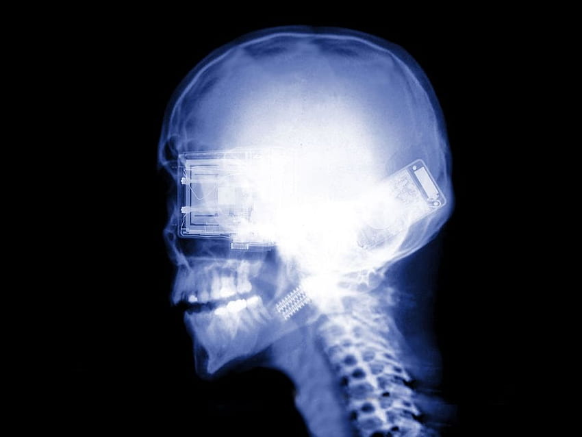 Raios X de implantes de crânio < Arte 3D < Galeria <, Radiologia papel de parede HD