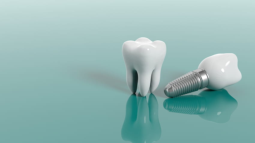 Зъбен имплант 101: Безопасни ли са зъбните импланти? (Отговорът е да!) - Аризонска пародонтална група HD тапет