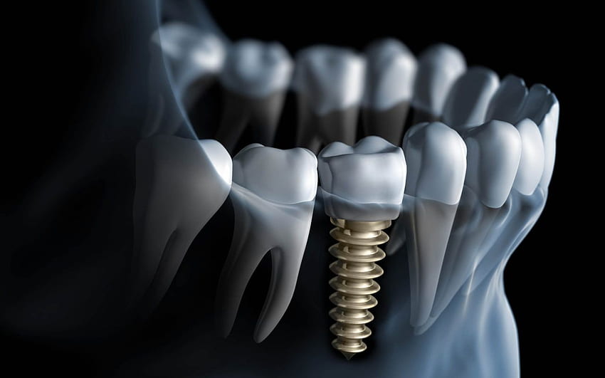 Implantes Dentários em Palm Harbor. Graça papel de parede HD