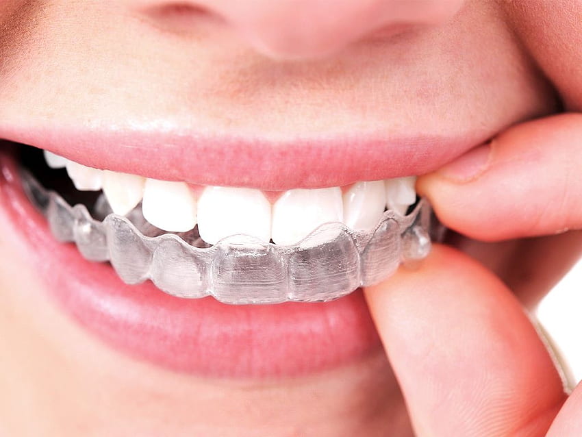 Smile Direct Club vs. Invisalign: Apakah Ada Pemenang yang Jelas, Smile Dental Wallpaper HD