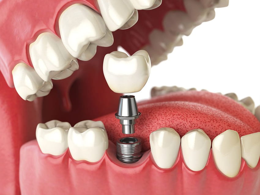 L'histoire des implants dentaires Fond d'écran HD