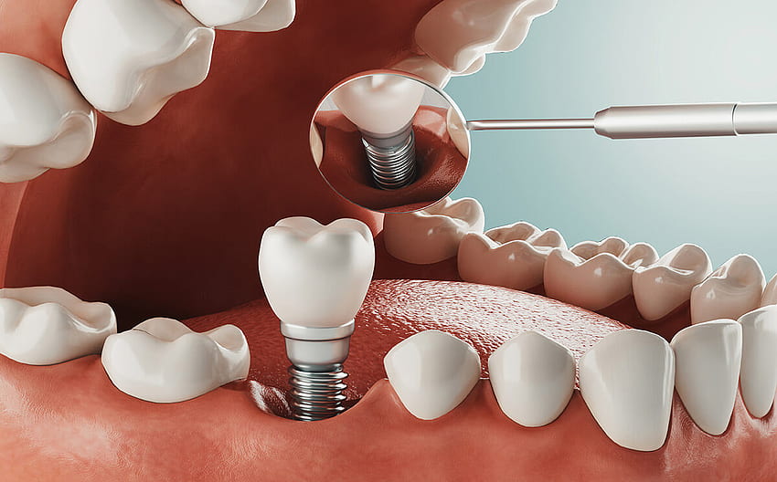 歯科インプラント周囲の出血 - 何をすべきか、治療 高画質の壁紙