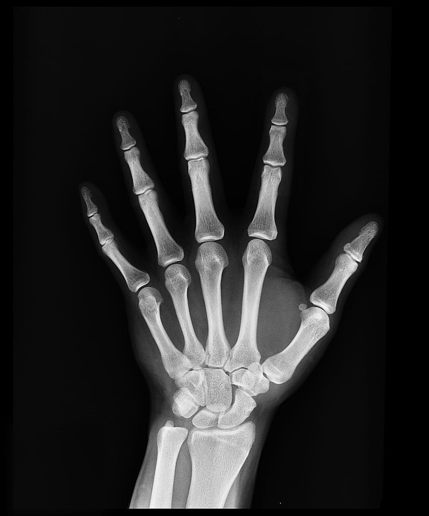 Hand X Ray Result · Stock , Skeleton Hand HD phone wallpaper