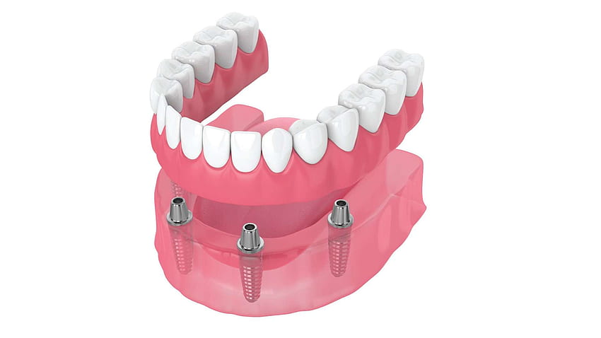 Replace All Your Teeth on Just Four Implants. Sleep Dentistry, Dental Implant HD wallpaper