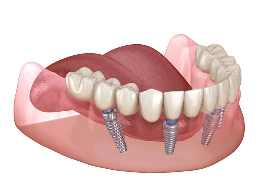 Ce que vous devez savoir sur les implants guidés. Soins dentaires Lasting Smiles Las Vegas Fond d'écran HD