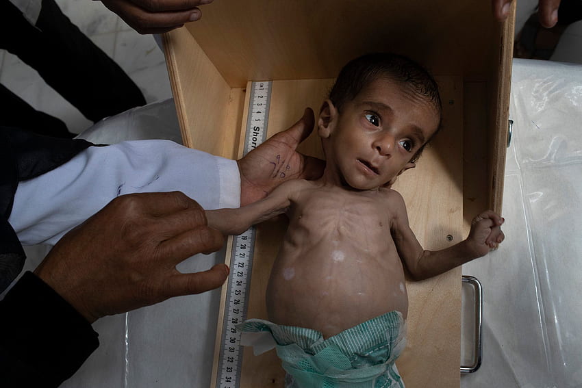 Why We Are Publishing Haunting of Emaciated Yemeni Children - The New York Times HD wallpaper