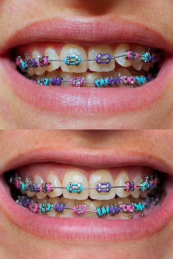 braces color ideas for girls