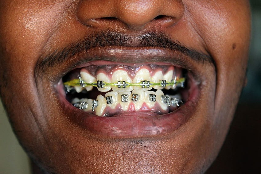 Man Teeth With Braces - Dental Braces - - teahub.io HD wallpaper