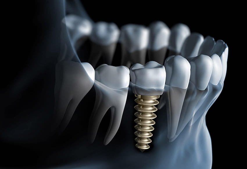 Os implantes dentários são seguros - o que você deve saber papel de parede HD