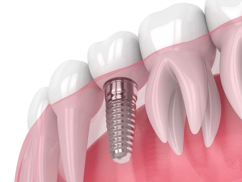 Implantes dentários. Drayton papel de parede HD